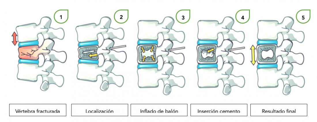 cifoplastia